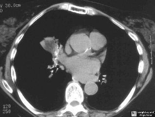 Lipoid pneumonia